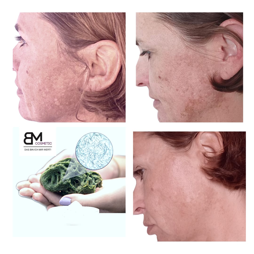 Bio Microneedling