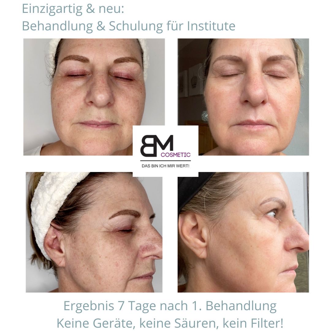 Bio Microneedling