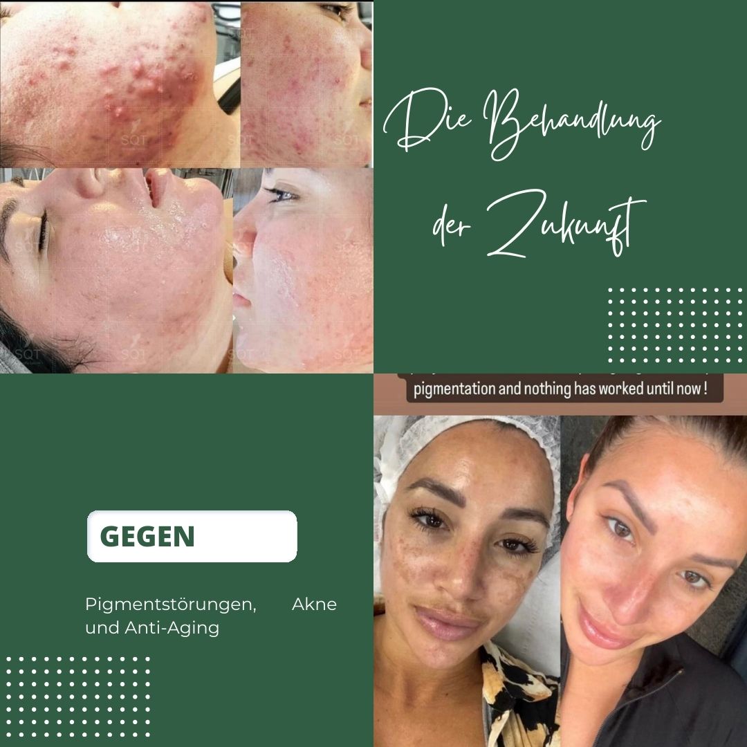 Bio Microneedling